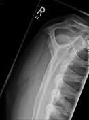 Case contributed by dr sajoscha sorrentino. Acromial Types Radiology Reference Article Radiopaedia Org