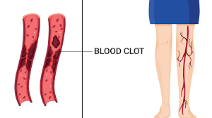 Signs and symptoms of blood clots depend upon their location and whether they occur in an artery or a vein. 10 Early Warning Symptoms Of A Blood Clot You Should Never Ignore