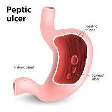 signs you may have a peptic ulcer