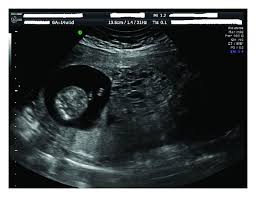 Ultrasound Image Of Twin Pregnancy With Molar Component