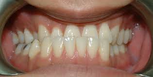 How do you make an underbite less noticeable? How To Fix An Underbite Without Surgery Hampstead Orthodontic Practice