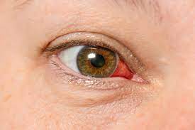 10 signs of corneal injury magruder