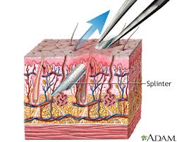splinter removal multia