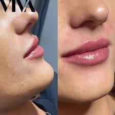 swelling last after lip filler