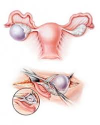 ovarian cysts women s care eugene