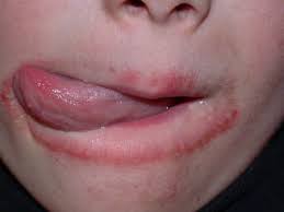 lip lickers dermais stamford skin