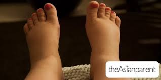 swollen feet during pregnancy what