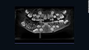 See more of the kid laroi. Doctors Find 526 Teeth In Boy S Mouth In India Cnn