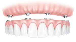 Melrose All-on-4 Dental Implants - University Associates in Dentistry