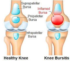Members of a carpet layers union required knee surgery, evacuation of knee effusions, and treatment of repeated joint infection. Knee Bursitis Symptoms Diagnosis Treatment