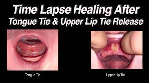 healing time lapse after tongue tie and