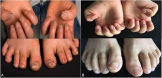 idiopathic 20 nail dystrophy bmj case