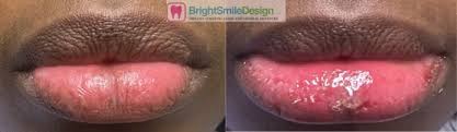laser lip depigmentation dark lip
