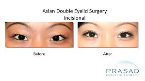 double eyelid surgery asian eyelid