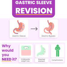 gastric sleeve revision reset your