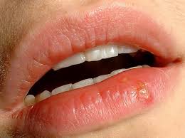 how to heal and prevent mouth sores