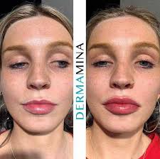 lip enhancement dermamina