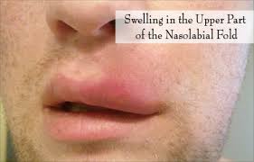 nasol cyst causes symptoms