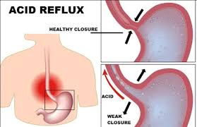 ayurvedic treatment of acid reflux