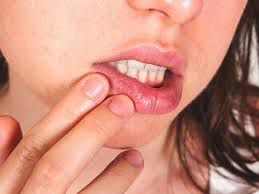 how to get rid of a cold sore fast