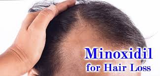 taking minoxidil for hair loss pros