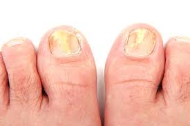 laser therapy for toenail fungus