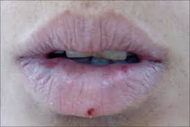 painful lesions on the lower lip