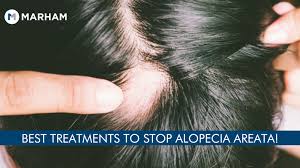 how to stop alopecia areata from