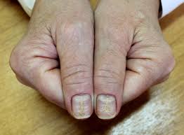 an ciform nail dystrophy
