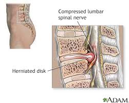 herniated disk information mount