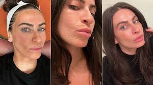 vi l gets rid of my stubborn melasma