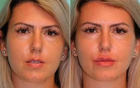 lip augmentation best lip injections