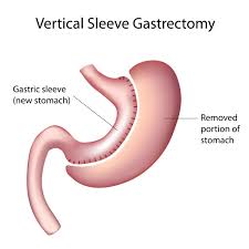 sleeve gastrectomy heywood hospital