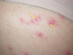 Folliculitis or hot tub rash as it is also known as a common problem. Pseudomonas Skin Infection Hot Tub
