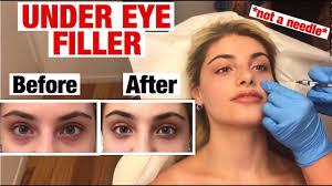 Ever since i was around 13 or 14 years old, i have turned to youtube videos with titles like how to get rid of bags, how to get rid of under eye circles. Under Eye Filler Injection For Dark Circles And Bags Before After Youtube