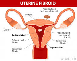 Endometriosis is often a painful condition in which the tissue that normally covers the inner part of. What Is A Retroflexed Uterus With Pictures