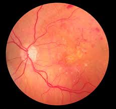 retina manhattan retina diseases