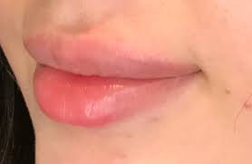 lip filler natural enhancement