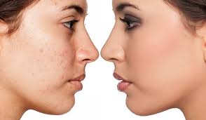 acne e skin for long lasting makeup