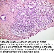 Pathology Outlines Grading Gleason