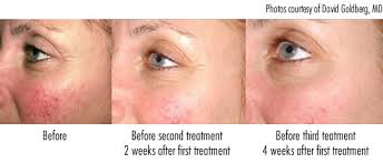 red spots and rosacea laser genesis