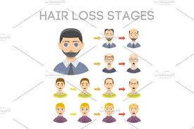 Information Chart Of Hair Loss Stages Types Of Baldness