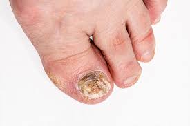 nail fungal infection