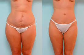 the truth about a tummy tuck what they