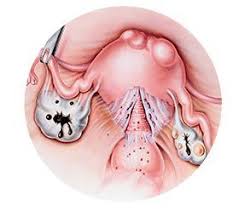 hysterectomies removal of the uterus