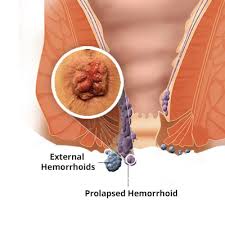 Below is a picture of grade 4 bleeding haemorrhoids. Hemorrhoid Treatment Specialist Nyc New York City Hemorrhoid Doctor