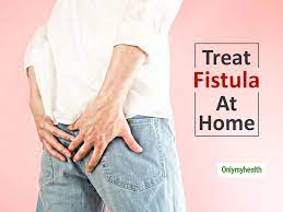 proven home remes for fistula to