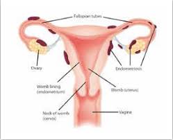 Endometriosis occurs most commonly within the fallopian tubes and on the outside of the tubes and. All You Need To Know About Endometriosis Vuk Uzenzele
