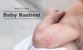 home remes for rashes articles