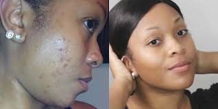 fade acne scars get clear skin